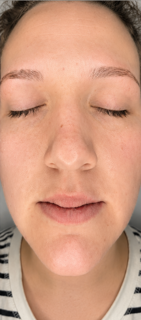 After — Sagging & fine lines