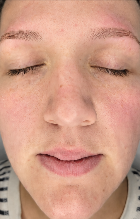 Before — Dark spots & uneven tone